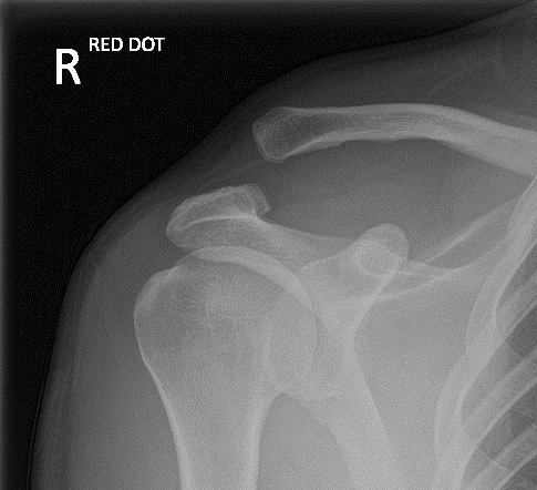 X-ray showing an acromioclavicular joint dislocation with widening at the top of the shoulder