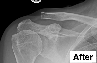 X-ray showing the acromioclavicular joint after ACJ excision