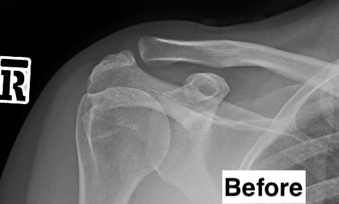 X-ray showing the acromioclavicular joint before ACJ excision