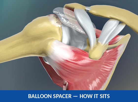 Diagram showing how the balloon spacer sits within the shoulder joint