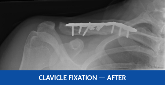 X-ray showing the clavicle fracture fixed with a plate and screws