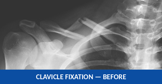 X-ray showing a displaced clavicle fracture before fixation
