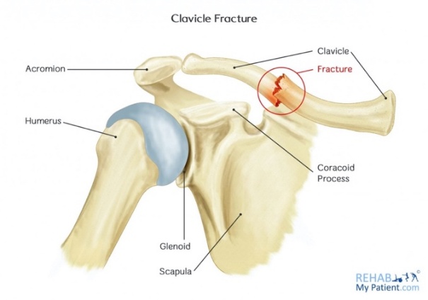 Diagram of the shoulder girdle showing the clavicle, acromion, coracoid process, humerus, glenoid and scapula, with the fracture site marked on the clavicle