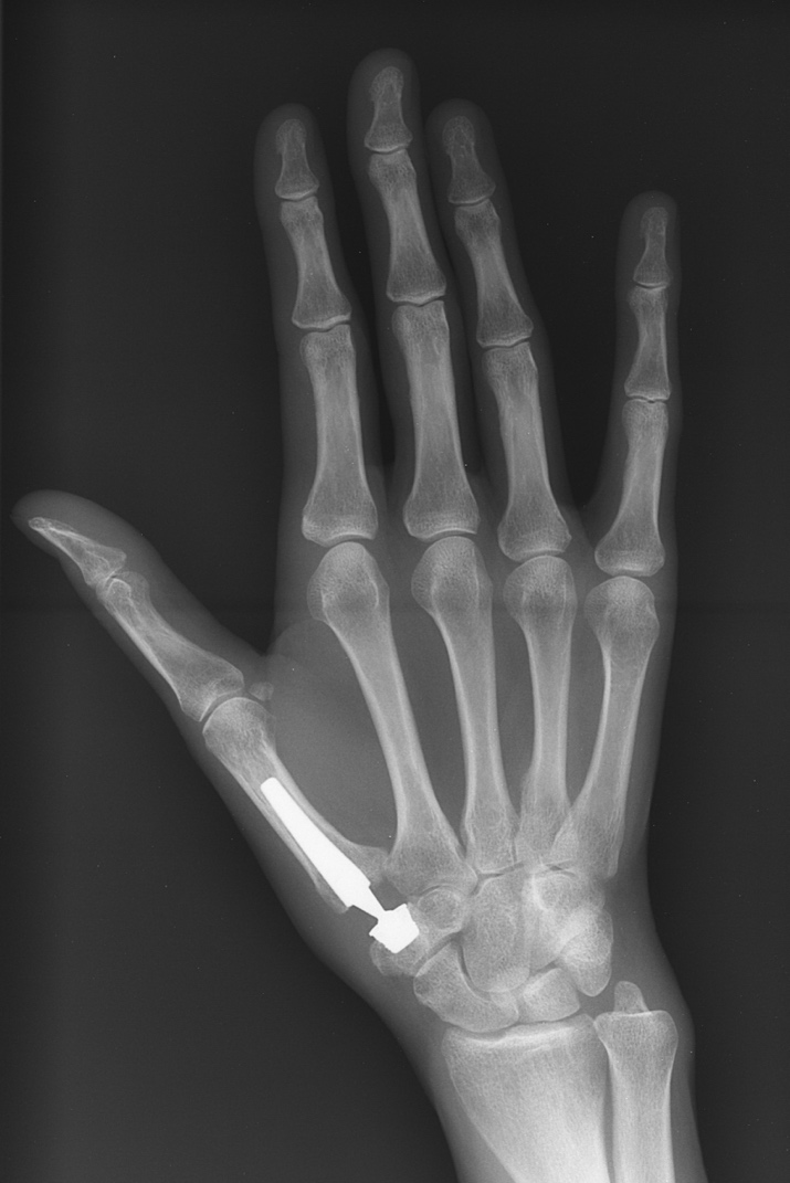 X-ray of the hand after thumb base joint replacement showing the artificial implant