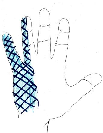 Hand drawing showing the area of numbness and tingling in the little and ring fingers, back-of-hand view