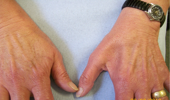 Clinical photograph showing muscle wasting in the hand in an advanced case of cubital tunnel syndrome