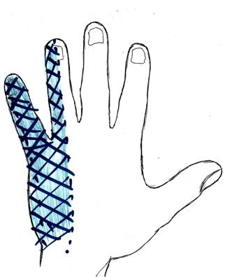 Hand drawing showing the area of numbness and tingling in the little and ring fingers, palm view