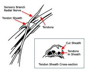 Diagram of the tendon sheath at the wrist showing the sensory branch of the radial nerve, tendons and a cross-section of the tendon sheath