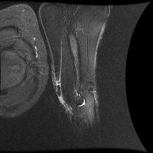 MRI scan of the elbow confirming a distal biceps tendon tear