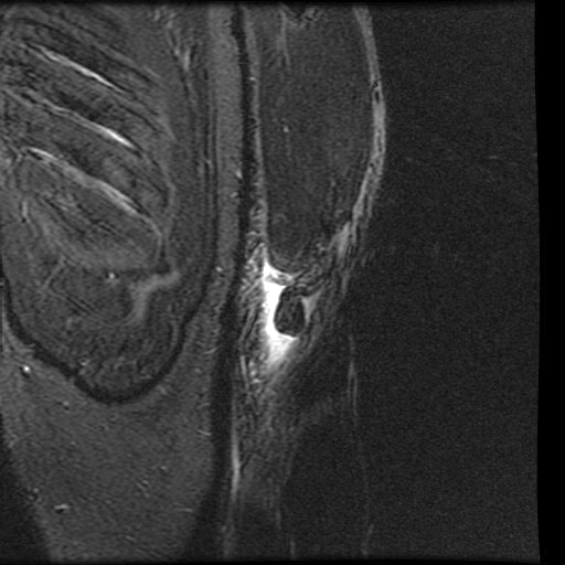 MRI scan showing the retraction of the torn distal biceps tendon