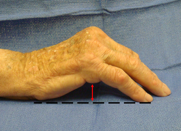 Photograph demonstrating a positive table-top test, where a hand affected by Dupuytren's contracture cannot be laid flat on a surface