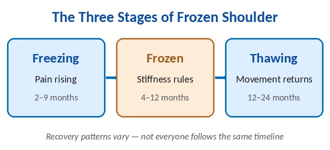 Diagram of the three stages of frozen shoulder: Freezing (2-9 months, pain rising), Frozen (4-12 months, stiffness rules), and Thawing (12-24 months, movement returns)
