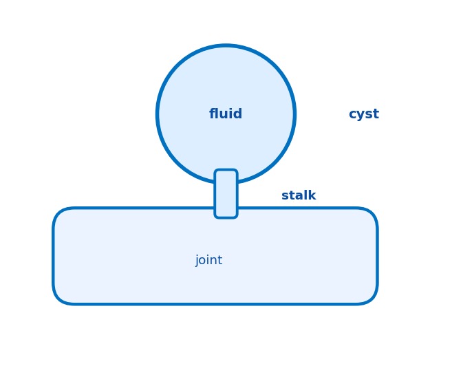 Diagram showing a ganglion cyst as a fluid-filled sac connected by a stalk to a joint