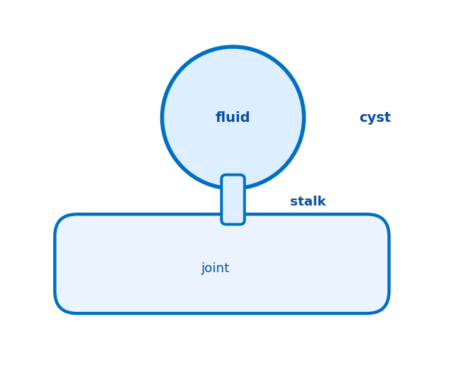 Diagram showing how a ganglion cyst forms, with fluid collecting in a sac connected to the joint by a stalk