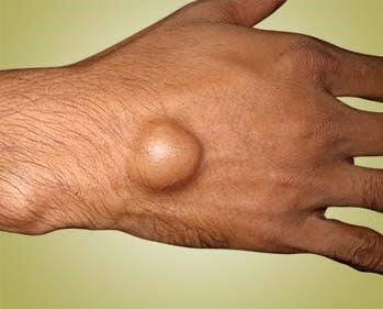 Photograph of a ganglion cyst on the back of the wrist