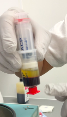 Preparation of a PRP (Platelet Rich Plasma) injection