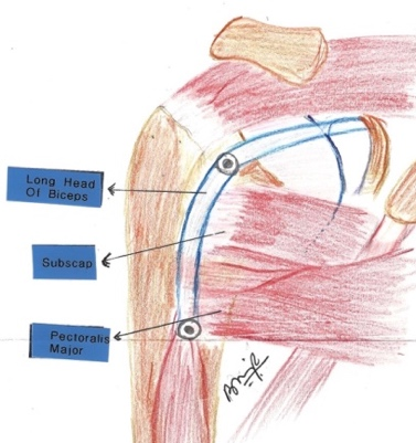 Illustration of the long head of biceps tendon running through the shoulder joint, past subscapularis and pectoralis major