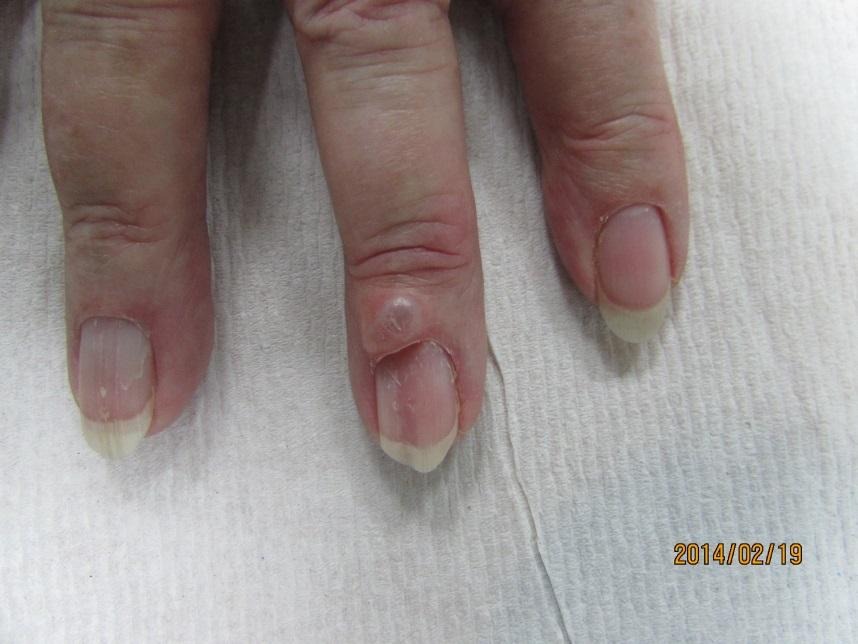 Photograph of a mucous cyst presenting as a small lump near the fingertip joint with a groove in the nail
