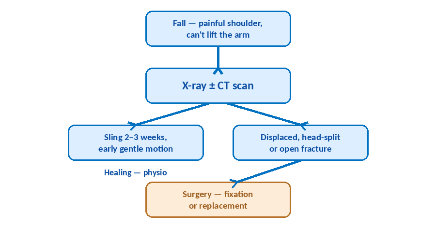 Flowchart of the management pathway for proximal humerus fracture: fall causing a painful shoulder, X-ray plus CT scan, then sling for 2-3 weeks with early gentle motion and physio if not displaced, or surgery — fixation or replacement — if displaced, head-split or an open fracture