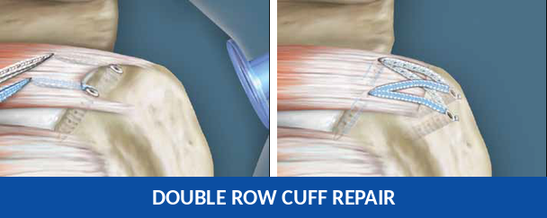 Diagram of double row rotator cuff repair technique