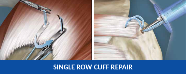 Diagram of single row rotator cuff repair technique