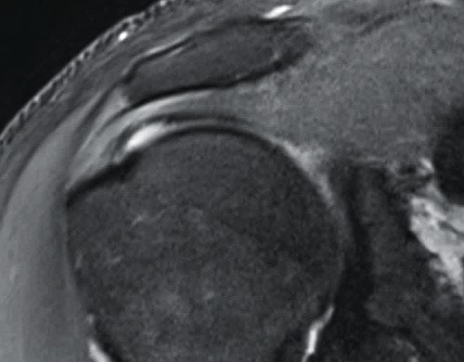 Additional MRI scan of the shoulder showing the rotator cuff