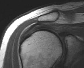 MRI of the shoulder showing a full-thickness rotator cuff tear