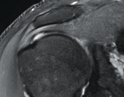 MRI of a normal, intact rotator cuff tendon for comparison