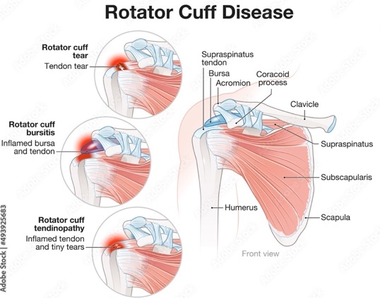 Diagram of rotator cuff disease showing a rotator cuff tear, rotator cuff bursitis with an inflamed bursa and tendon, and rotator cuff tendinopathy with an inflamed tendon and tiny tears