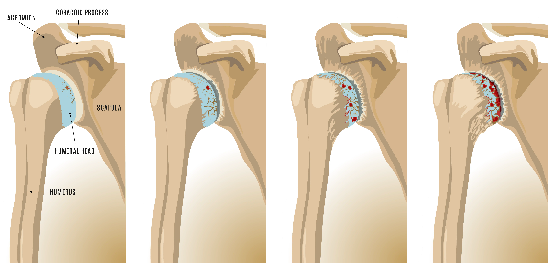 Diagram showing the progressive stages of cartilage wear in the shoulder joint, from healthy cartilage to advanced bone-on-bone arthritis
