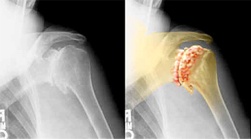 X-ray showing degenerative changes of shoulder arthritis, with a highlighted overlay marking the area of joint wear
