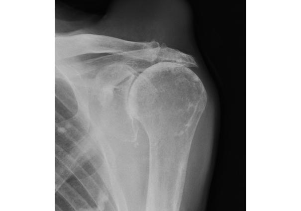 Additional example X-ray of the shoulder joint