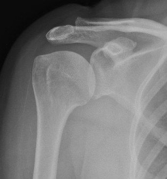 X-ray showing cuff tear arthropathy — shoulder arthritis associated with a long-standing large rotator cuff tear