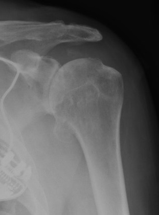 X-ray showing osteoarthritis of the shoulder joint