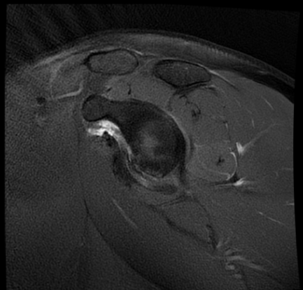MRI scan of the shoulder showing a Bankart tear of the labrum