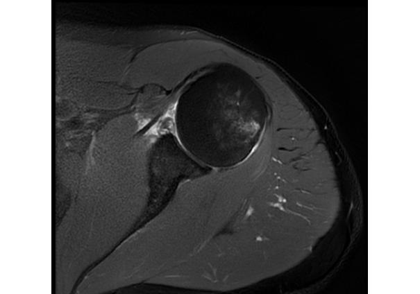 MRI scan of the shoulder showing the labrum around the glenoid socket