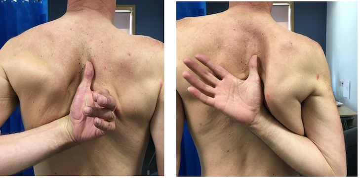 Clinical examination photo comparing how high the patient can reach up their back with each hand, used to assess internal rotation