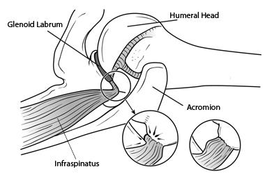 Diagram showing the mechanism of internal impingement — the humeral head and greater tuberosity contacting the back-top rim of the socket, pinching the rotator cuff and labrum