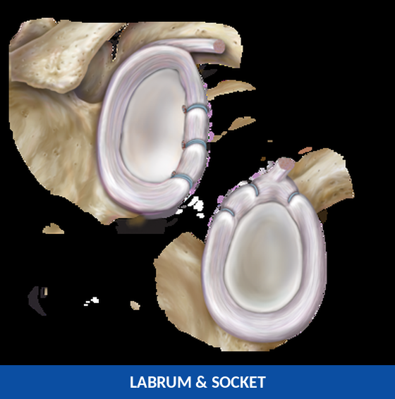 Diagram of the labrum and socket showing anchor placement for SLAP repair