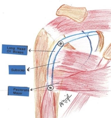 Illustration of the long head of biceps, subscapularis and pectoralis major tendons around the shoulder joint