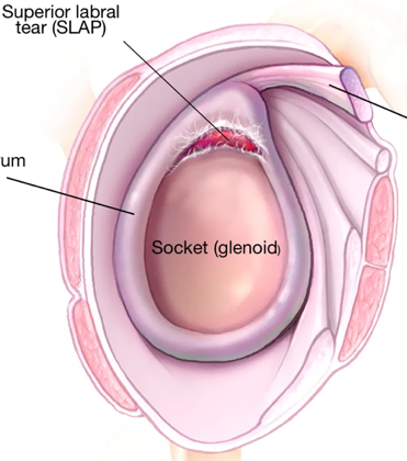 Diagram of a superior labral tear (SLAP) at the top of the shoulder socket (glenoid)