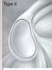 Illustration of a Type II SLAP tear of the shoulder labrum