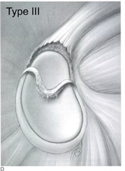 Illustration of a Type III SLAP tear of the shoulder labrum