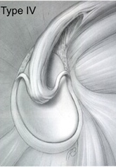 Illustration of a Type IV SLAP tear of the shoulder labrum