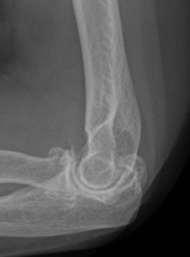 Clinical photograph of a patient's elbow