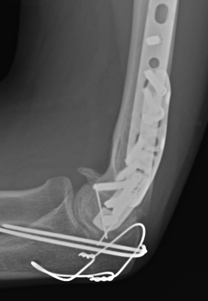 X-ray of the elbow showing surgical fixation hardware following a previous fracture