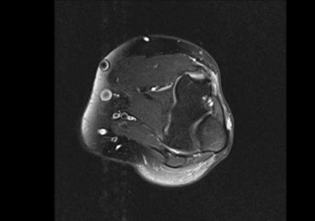 MRI scan of the elbow, axial view