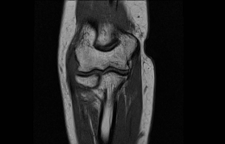 MRI scan of the elbow, coronal view