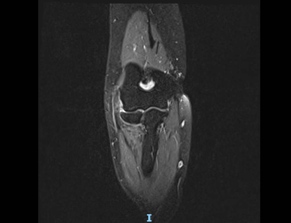 MRI scan of the elbow, sagittal view, used to evaluate soft tissue damage