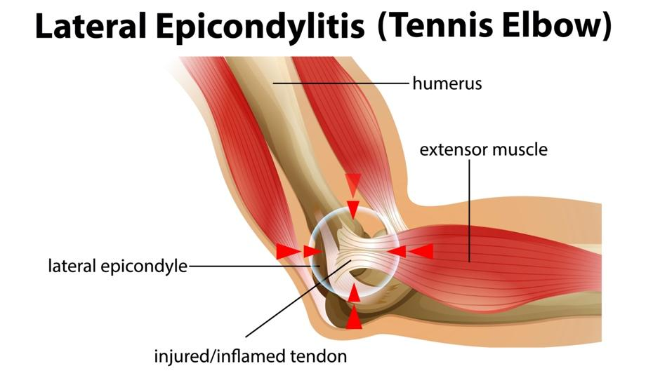 Diagram of lateral epicondylitis (tennis elbow) showing the injured extensor tendon at the lateral epicondyle